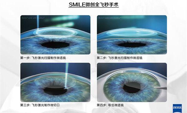 武汉哪家医院近视好？82%患者选择普瑞眼科