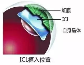 3分钟搞懂ICL近视手术!