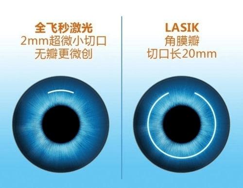 全飞秒激光引领近视手术新趋势