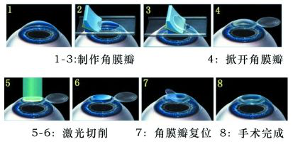 近视眼手术费用