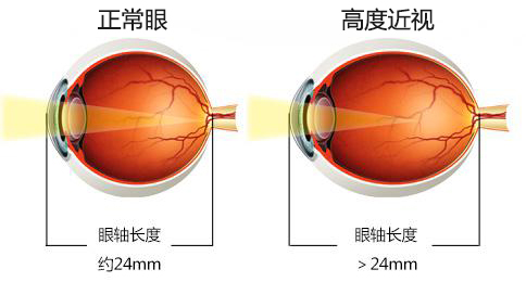 高度近视怎么