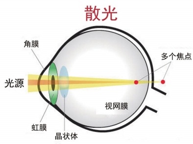 详细解读V4C-ICL人工晶体植入术中的TCA技术