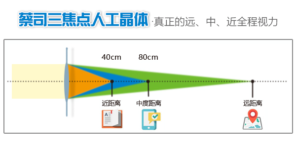 做白内障手术好吗？