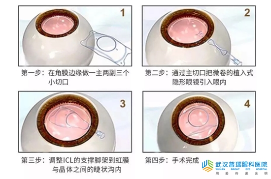 武汉普瑞眼科精 准ICL人工晶体植入术，大幅提升手术精 准性